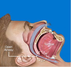 Non-Obstructed Airway