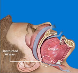 Obstructed Airway